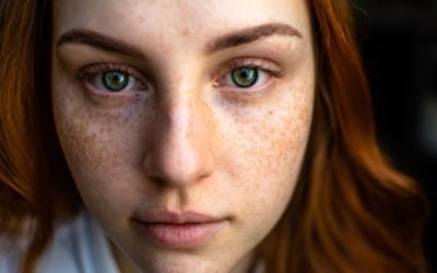 l'hyperpigmentation